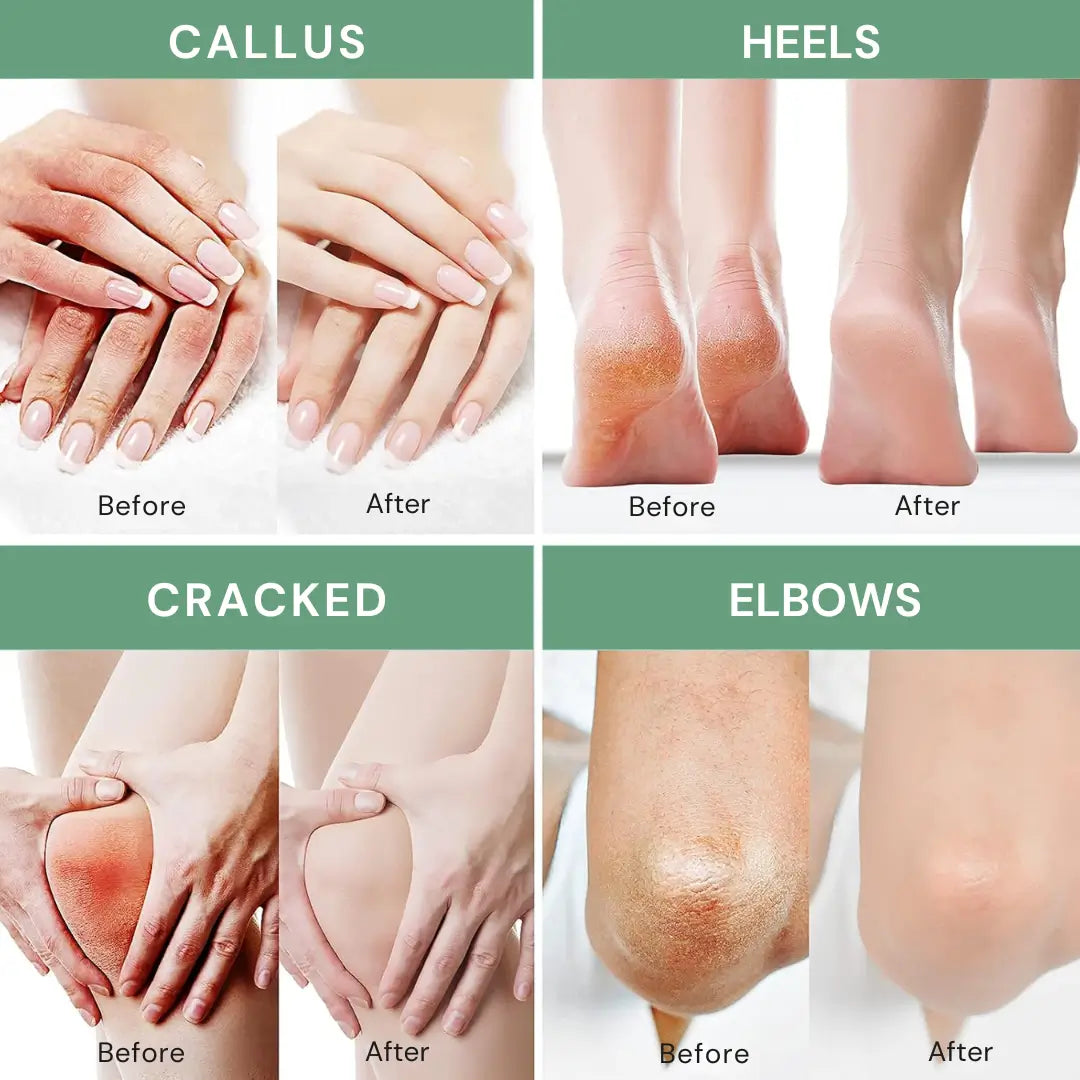 Urea Callus & Dry Skin Cream