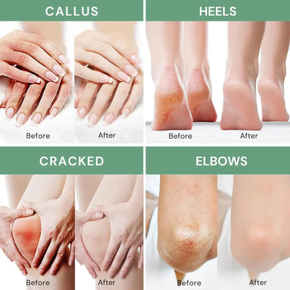 Urea Callus & Dry Skin Cream
